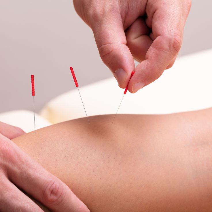 Akupunktur